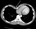 Mediastinal shift