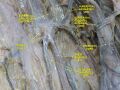 Spermatic cord