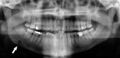 Panoramic radiograph showing Stafne defect