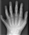 Polydactyly left hand AP