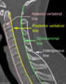 Vertebral lines