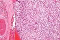 Carotid body tumor
