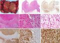 Histopathology of a pheochromocytoma with coagulative necrosis, with immunostaining