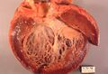 Gross pathology of idiopathic cardiomyopathy