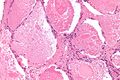 Pulmonary alveolar proteinosis under high magnification