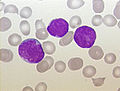 ALL - Peripheral Blood - Diagnosis