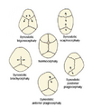Single suture synostosis