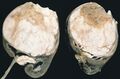 Wilms tumor