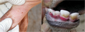 Bovine papular stomatitis