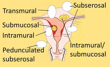 Medical illustration showing the locations of fibroids within the uterus.