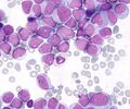 Acute Myeloid Leukemia (M2 type)