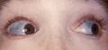 Characteristically blue sclerae of patient with osteogenesis imperfecta