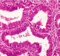 Ovarian tumor