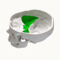 Middle cranial fossa animation