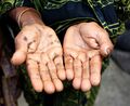 Arsenic Poisoning