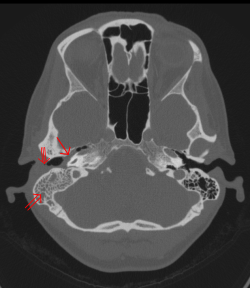 Otitis Media Mastoiditis