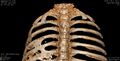 Diffuse idiopathic skeletal hyperostosis