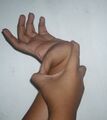 Hypermobility 11