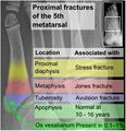 Proximal fractures of 5th metatarsal