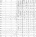 Neural oscillation