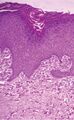 Histopathology of perforating calcific elastosis