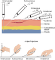 Needle insertion angles