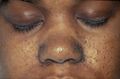 Patient with facial angiofibromas caused by tuberous sclerosis