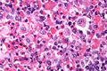 Hemophagocytosis