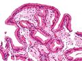 Gallbladder cholesterolosis intermediate magnification cropped