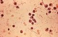 Shigella bacteria in stool sample