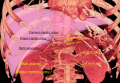 Common hepatic artery