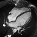 Cardiac magnetic resonance imaging