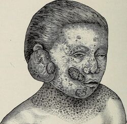 Xeroderma pigmentosum