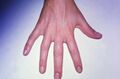 Arthritis on the Right Hand