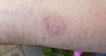 Dermatophytosis 7