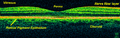 Optical coherence tomography of the retina
