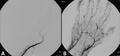 Angiograph before and after thrombolytic therapy in a case of thrombosis on the hand