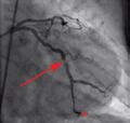 Coronary angiography showing partial occlusion of left circumflex coronary artery