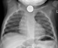 Foreign body aspiration