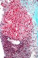 Hepatocellular carcinoma intermediate magnification