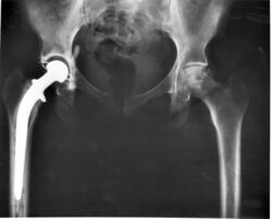 Hip replacement