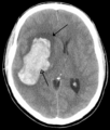 Parachemableed with edema