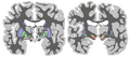 Coronal sections of the basal ganglia