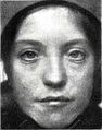 Patient with Waardenburg-Klein syndrome (1916)
