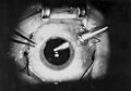 Vitrectomy procedure in progress