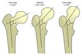 Diagram showing angles of the femur