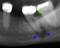 Tooth decay and abscess x-ray