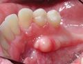 Oral_torus