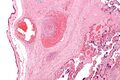 Micrograph showing a fetal (placental) vein thrombosis, in a case of fetal thrombotic vasculopathy. This is associated with cerebral palsy and is suggestive of a hypercoagulable state as the underlying cause.