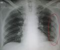 Fractured ribs marked